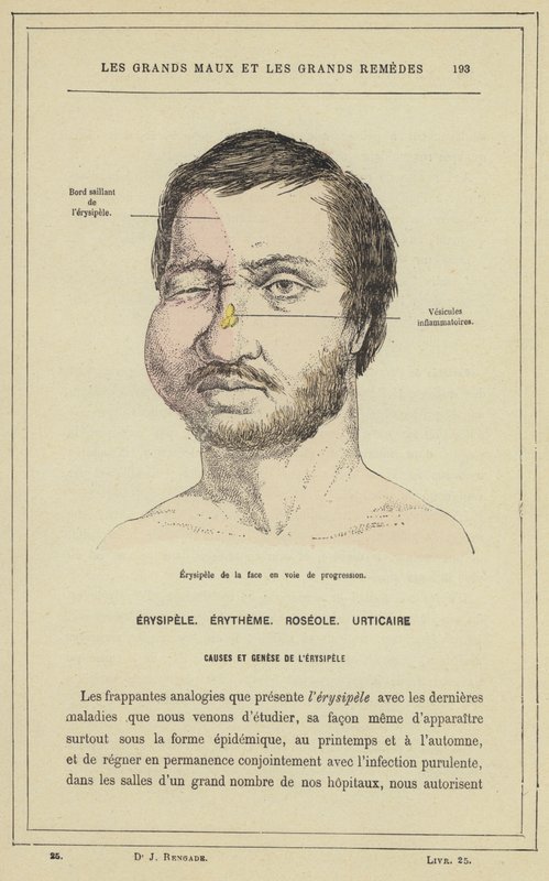 Erisipela de la cara en progreso de French School
