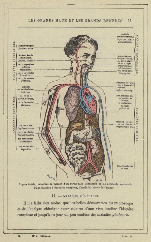 Figura ideal, mostrando el curso de un virus en el cuerpo y los accidentes sucesivos de una diátesis de evolución completa, según la teoría del autor de French School