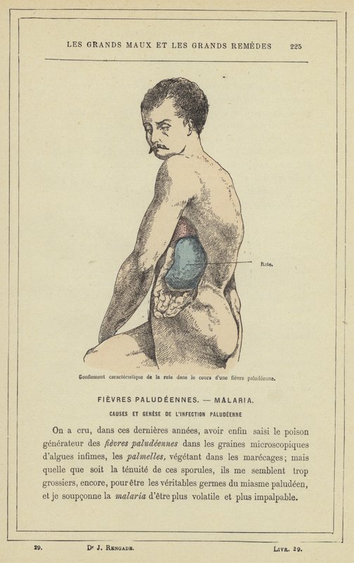 Hinchazón característica del bazo durante una fiebre palúdica de French School