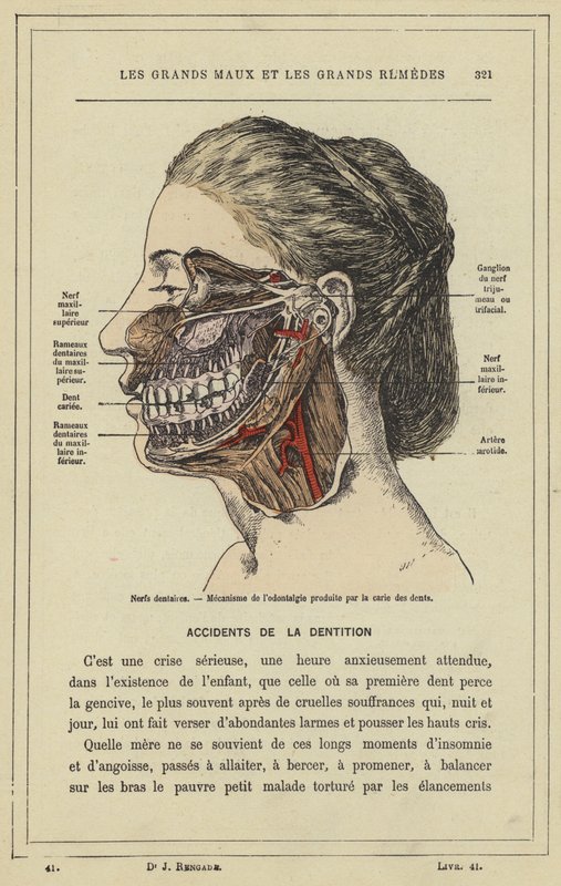 Nervios dentales, Mecanismo del dolor dental producido por la caries de French School