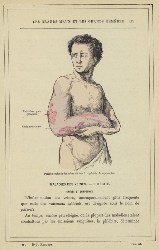 Flebitis profunda de las venas del brazo en el período de supuración de French School