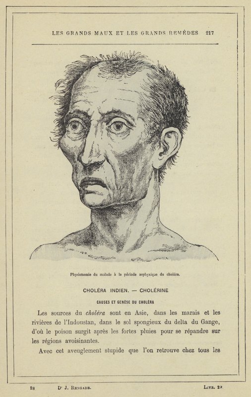 Fisonomía del enfermo en el período asfíxico del cólera de French School