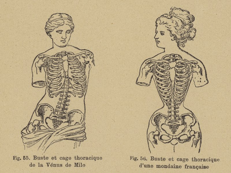 Comparación de la forma del pecho y la caja torácica de la Venus de Milo con la de una socialité francesa de finales del siglo XIX de German School