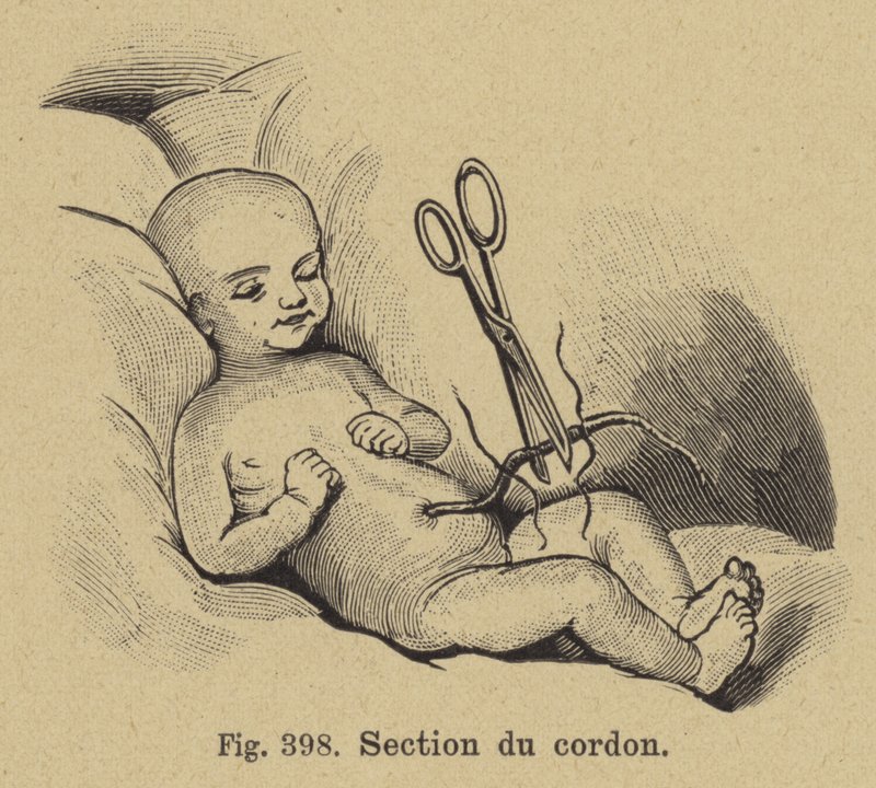 Corte del cordón umbilical de un recién nacido de German School