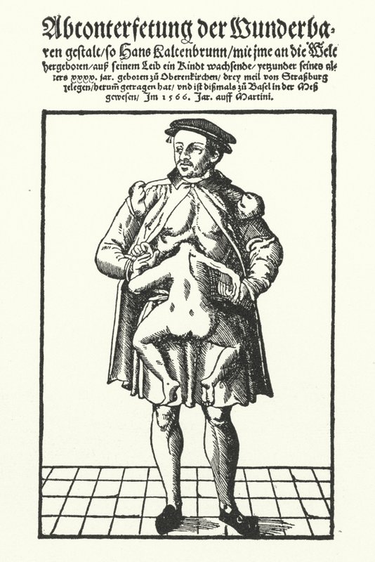 Hans Kaltenbrunn y su gemelo unido no desarrollado de German School
