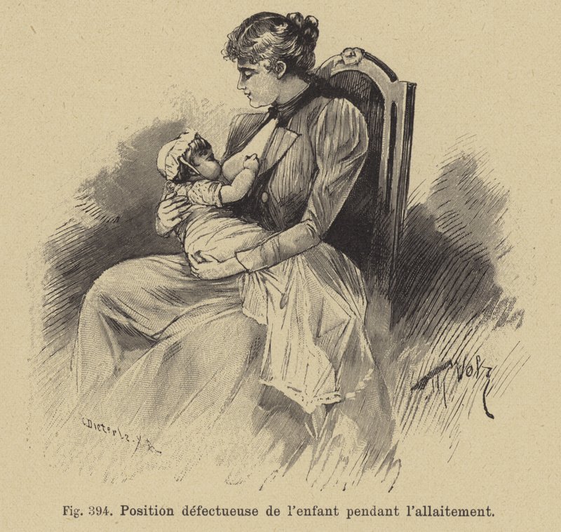 Posición incorrecta de un bebé durante la lactancia de German School