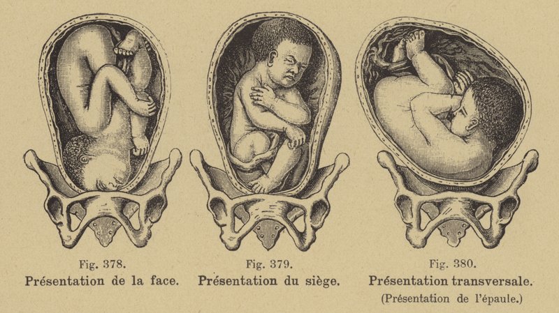 Malpresentación de bebés en el útero antes del nacimiento de German School