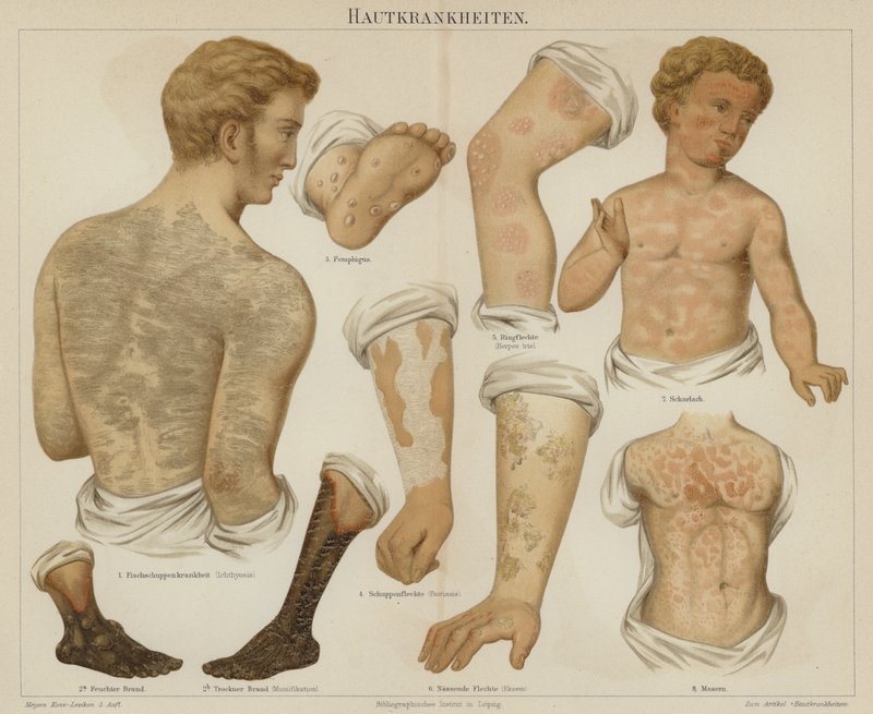 Trastornos de la piel (litografía en color) de German School