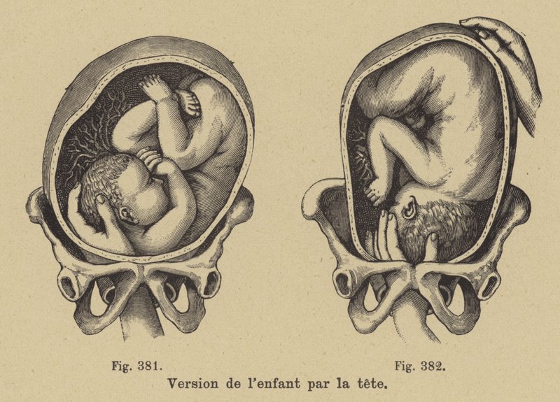Girando a un bebé en el útero de su madre para que la cabeza esté hacia abajo antes del nacimiento de German School
