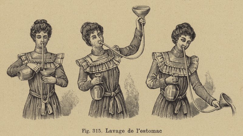 Lavado de estómago de German School