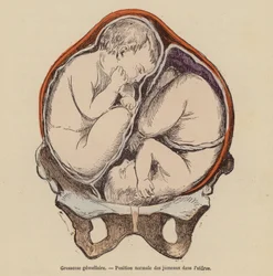 Posición normal de los gemelos en el útero durante el embarazo (grabado en color)