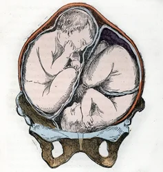 Representación de la buena posición de dos fetos durante un embarazo gemelar Grabado de "La nature et l