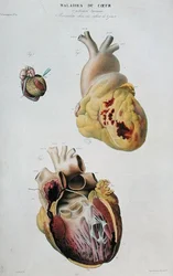 Placa que representa enfermedades del corazón. Ruptura espontánea del corazón de una mujer de 86 años (fig. 1) y pericarditis en un bebé de seis días (fig. 2), de 