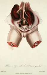 Hernia inguinal del ovario izquierdo, de 