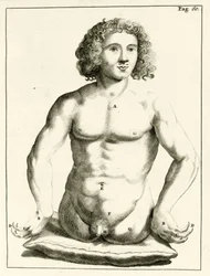Ejemplo de defectos congénitos, de Exercitationes Practicae circa Medendi Methodum por Frederik Dekkers, 1694
