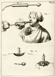 Usando una jeringa para administrar un purgante, de Exercitationes Practicae circa Medendi Methodum por Frederik Dekkers, 1694