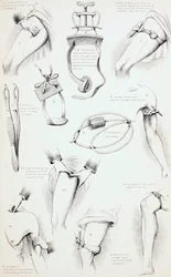 Métodos para Detener el Sangrado, c.1890