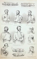 Tratamiento Temporal de Fracturas, c.1890