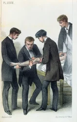 Amputación de un brazo, de un manual médico por Jean-Baptiste-Leon Dubreuil, c.1850-60