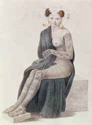 Ictiosis congénita, de un libro de G.M. Olbers, 1830