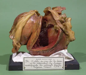 Modelo de un tumor del ventrículo izquierdo, 1799