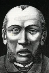 Paciente con reblandecimiento cerebral (grabado) 1888
