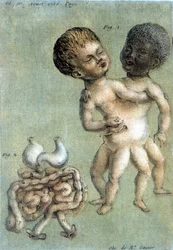 Lámina médica que representa gemelos siameses: una persona blanca y una persona negra. Ilustración de Toussaint (1756) en „Observations périodiques sur la physique, l