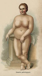 Retrato de una mujer con obesitis patológica (impresión)
