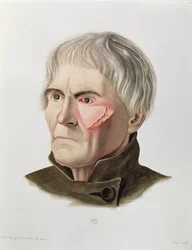 Operación de injerto de piel, de Selecta Praxis Medico-Chirurgica por Alexander Auvert, París, 1856