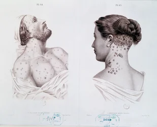 Síntomas de sífilis en hombres y mujeres, de un libro médico, c.1850-60