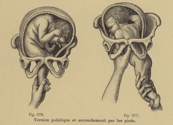 Parto de nalgas (nacimiento de pies)