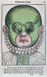 Máscara para tratar un estrabismo, de Ophthalmodouleia por Georg Bartisch (1535-1636) publicado en Dresde en 1583