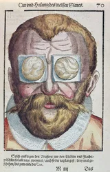 Tratamiento de una afección ocular, de Ophthalmodouleia por Georg Bartisch (1535-1636) publicado en Dresde en 1583