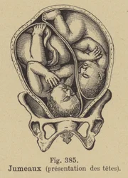 Gemelos en el útero de su madre
