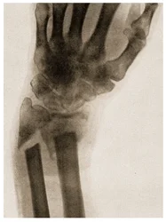 Radiografía de una muñeca fracturada c.1890
