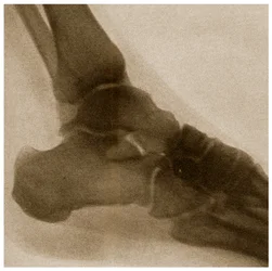Radiografía de un tobillo c.1890