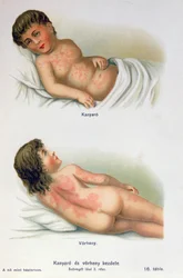 Sarampión y escarlatina, de un libro médico familiar, c.1900