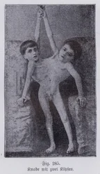 Giacomo y Giovanni Battista Tocci, gemelos siameses italianos