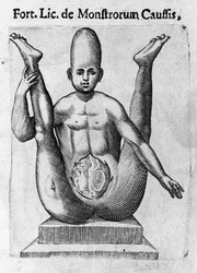 Monstruo humano: una criatura con un cráneo enorme, con intestinos aparentes. Grabado de “De monstrorum natura, causis et differentiis” por Fortunio Liceti (1577-1656), científico italiano. 1646