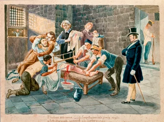 El patriota y miembro de la Carboneria Pietro Maroncelli (1795-1846) sufrió la amputación de la pierna durante su encarcelamiento en la penitenciaría de la fortaleza de Spielberg, en Moravia. Grabados del siglo XIX, Museo del Risorgimento, Milán