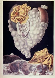 Cáncer - de Cruveilhier