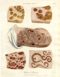 Cambios patológicos de la piel: Variedades de psoriasis