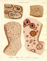 Condiciones Patológicas de la Piel: Schurigie;Piel Leprosa;Pallada e Impétigo