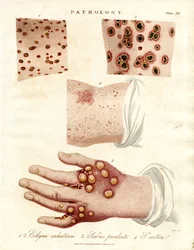 Enfermedades de la piel: Ectima;Sarna Purulenta y Viruela