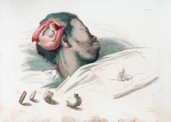 Vista de una herida en el cráneo después de la trepanación y la extracción del fragmento de hueso astillado en la parte inferior izquierda, 1821