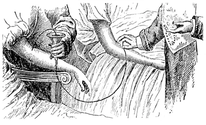 Transfusión de sangre, c1880