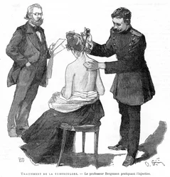 El profesor Bergmann inyectando a un paciente de tuberculosis, 1891