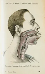Uso de un laringoscopio para ayudar a la extracción de un pólipo de la garganta, c. 1890