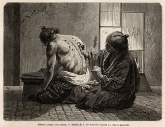Un médico aplicando moxas (pequeños conos de artemisa quemados en partes específicas del cuerpo), un tratamiento preventivo contra varios síntomas desde la indigestión hasta la falta de apetito, el llanto y el dolor de muelas, empleado dos veces al año y c