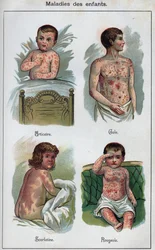 Enfermedades de los niños: Urticaria, sarampión, sarna, escarlatina. En “La nueva medicación natural” por F.E. Bilz